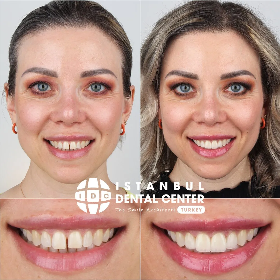 Before and after treatment at Istanbul Dental Center