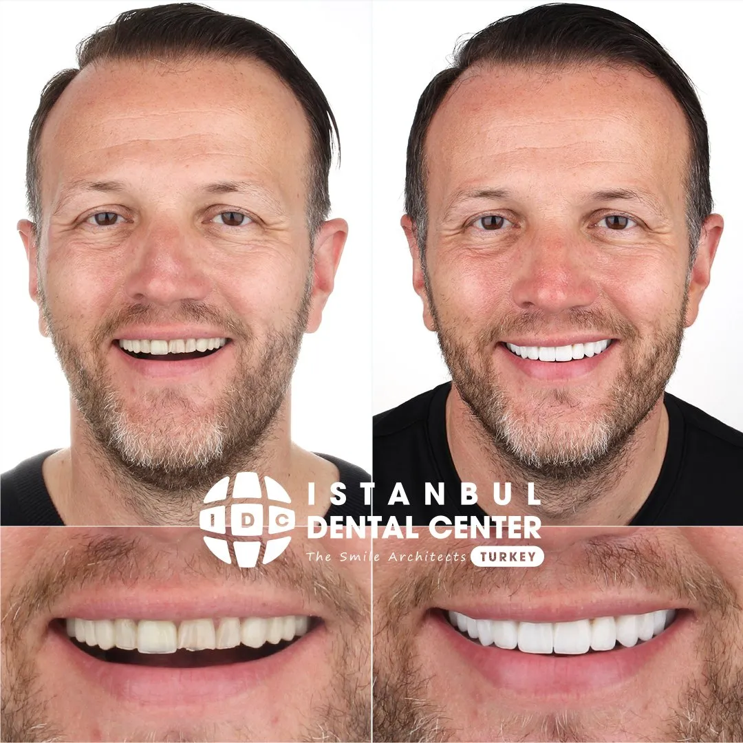 Before and after treatment at Istanbul Dental Center