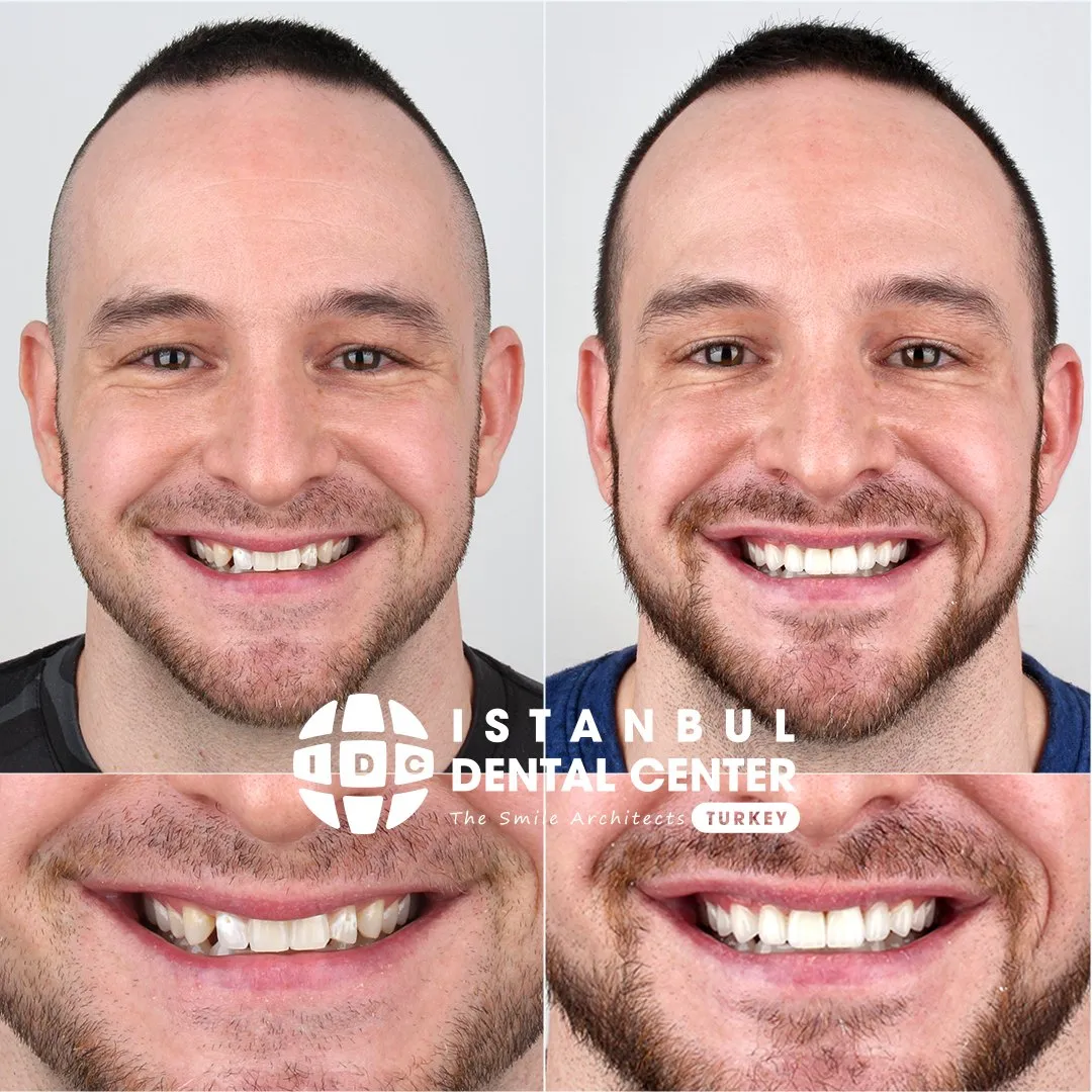 Before and after treatment at Istanbul Dental Center