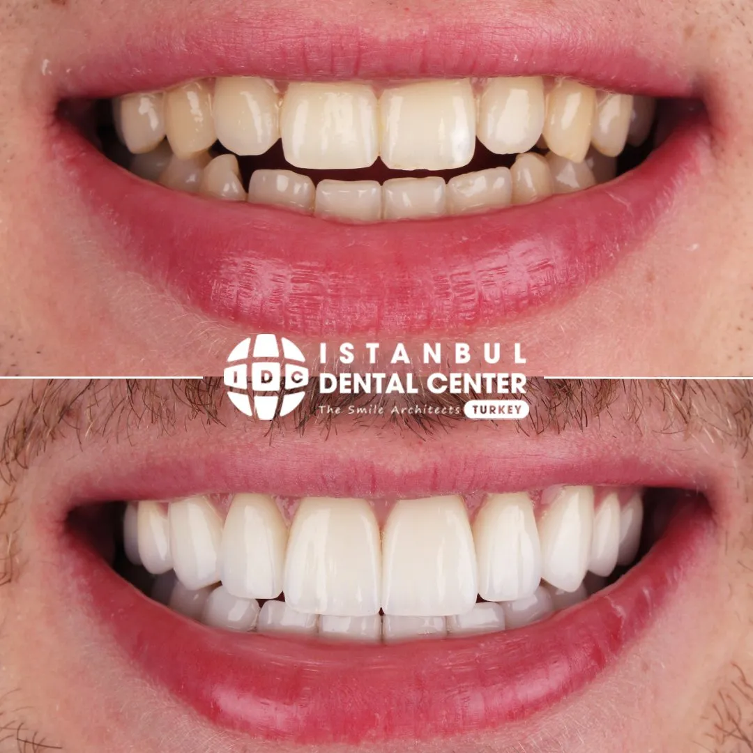 Before and after treatment at Istanbul Dental Center