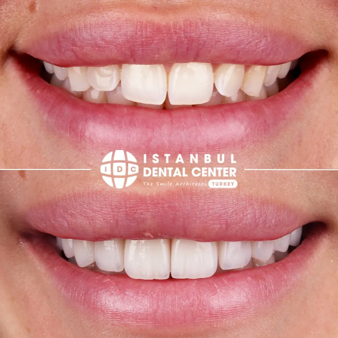 Before and after treatment at Istanbul Dental Center