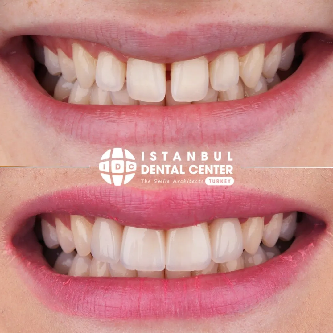 Before and after treatment at Istanbul Dental Center