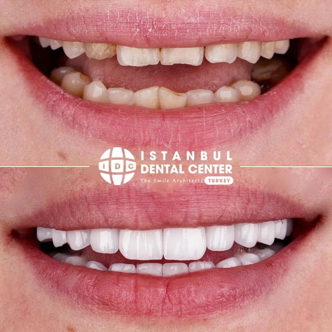 Before and after treatment at Istanbul Dental Center
