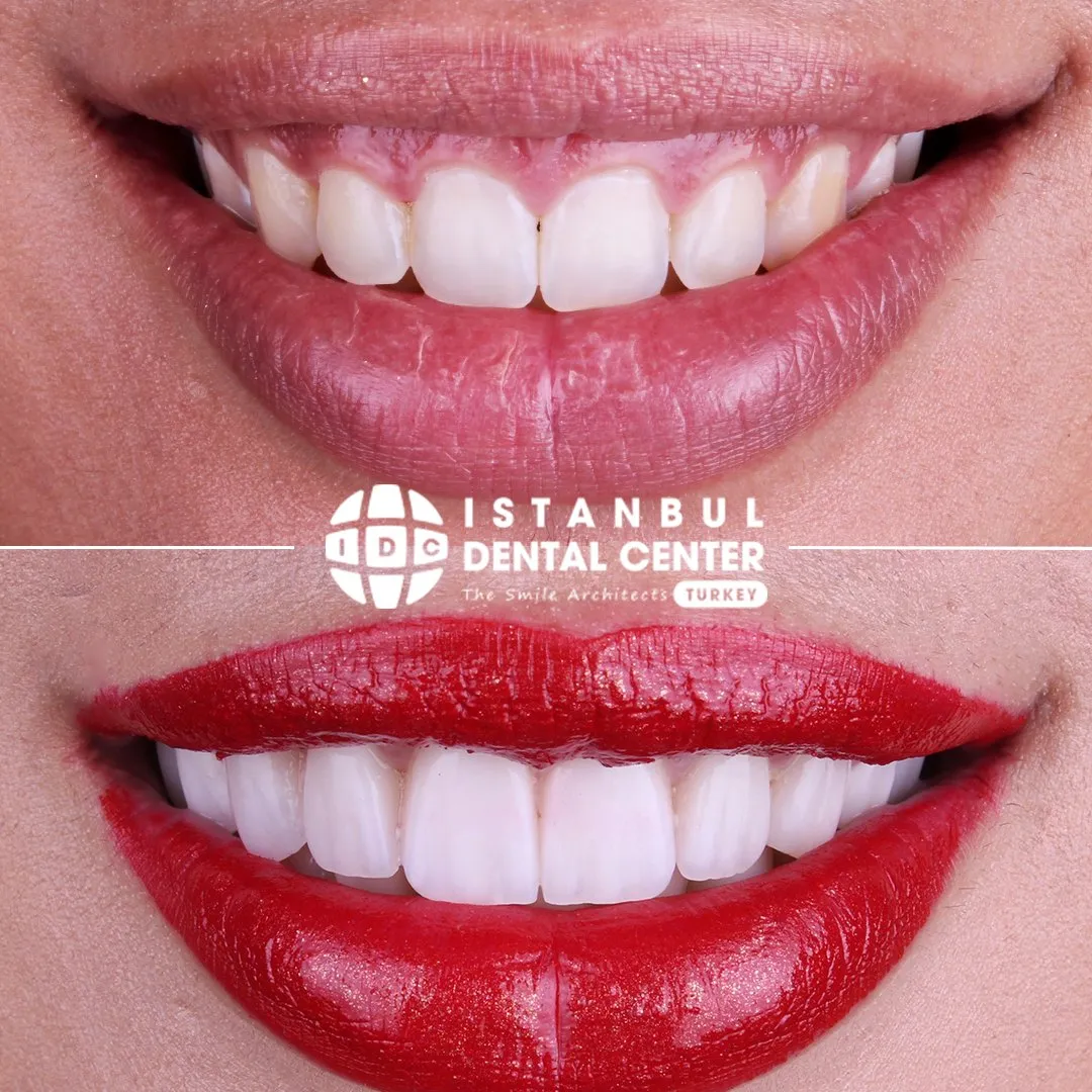 Before and after treatment at Istanbul Dental Center