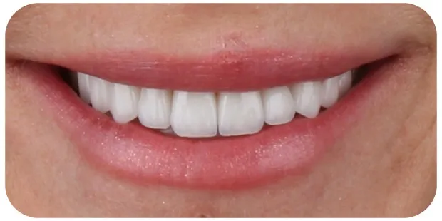 Smile after cosmetic treatment of the upper teeth