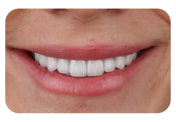 A woman's smile with even, white upper teeth