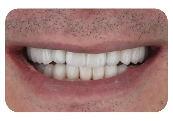 A man's smile with white upper teeth