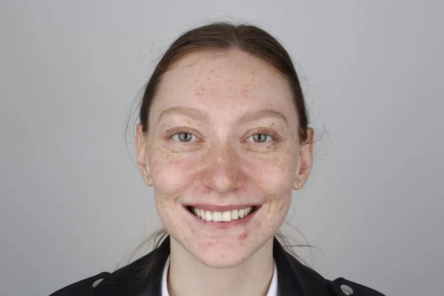 Patient smiling after treatment