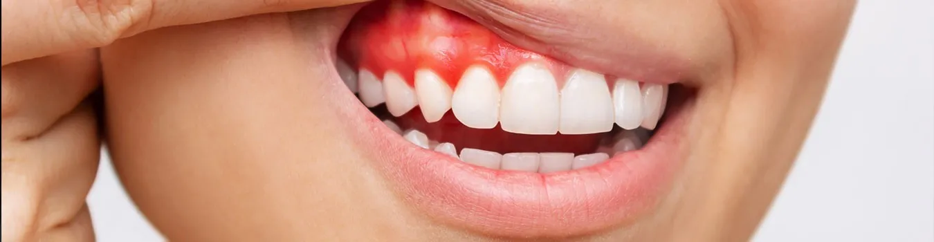 Close-up of red, inflamed gums above the front teeth